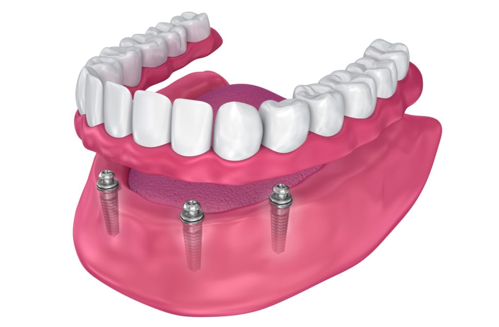 A 3D illustration of an overdenture to be seated on implants with ball attachments