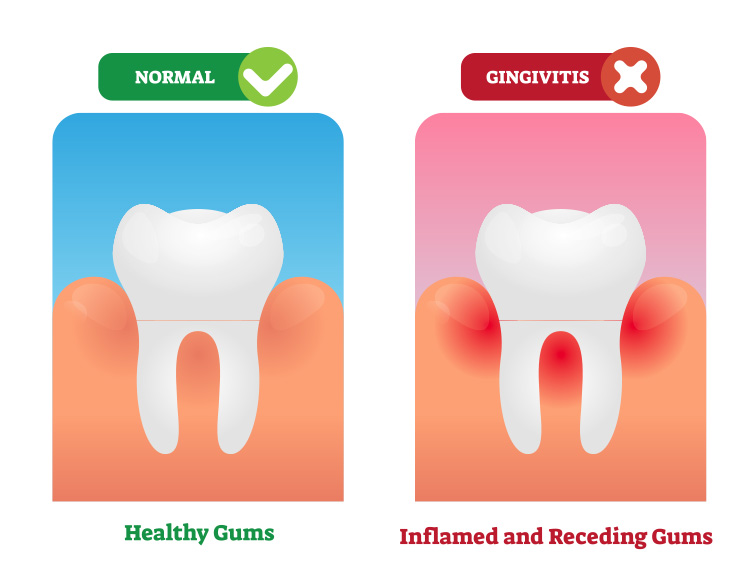 Gingivitis