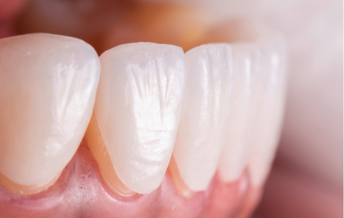 A close up of a woman's mouth while a dentist holds up a veneer to correctly match the natural colour of her teeth
