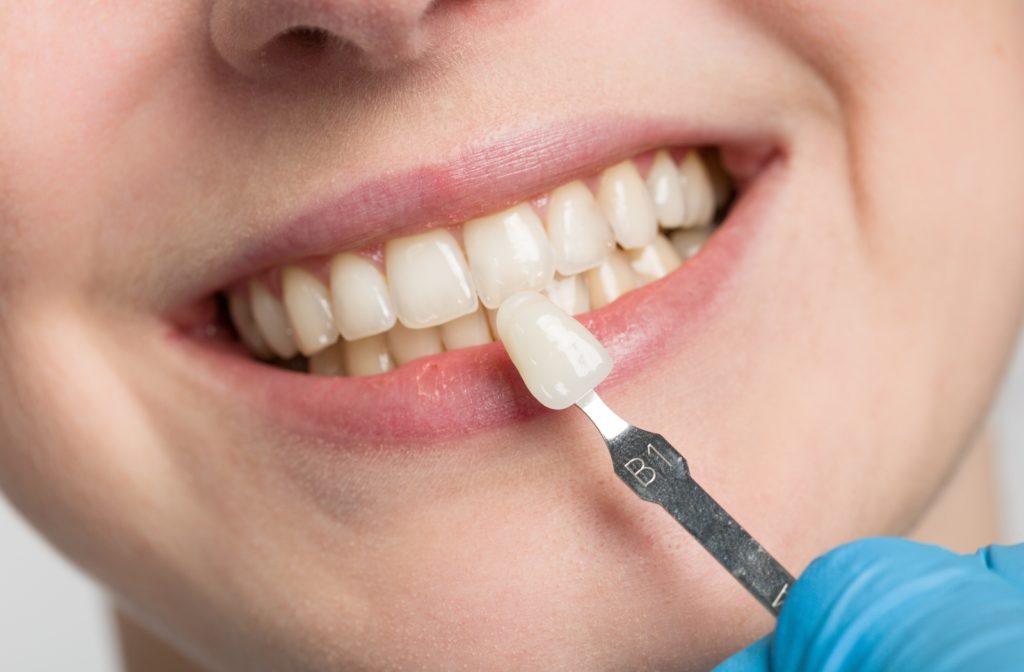 A close up look of veneers applied to the natural teeth