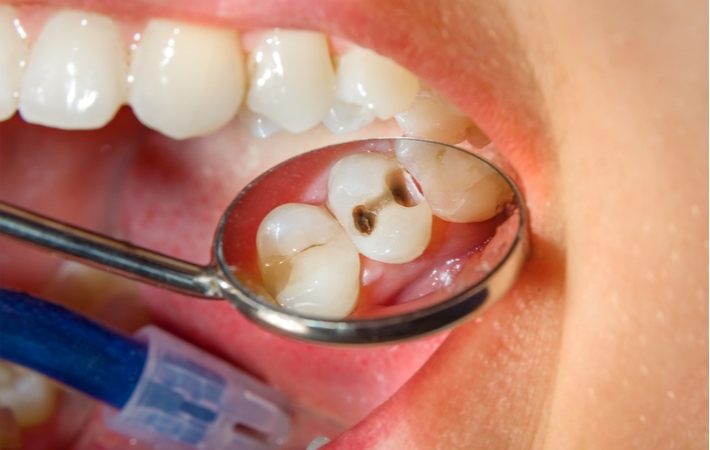 A close up of someone's mouth at the dentist who is using a small dental mirror to get a better view of a cavity