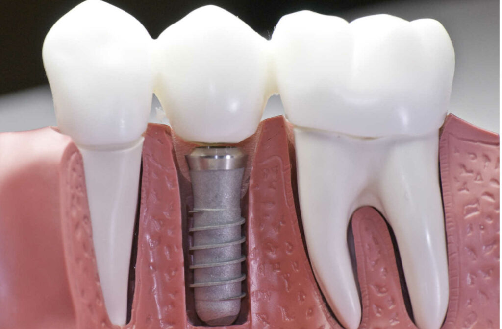 A model of a mouth showing how a tooth implant fits into your gums and jaw.