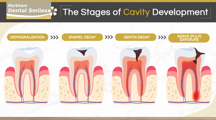 Stages of cavity development.