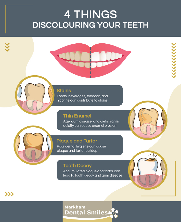 an infographic showing 4 things that can cause tooth discolouration. 