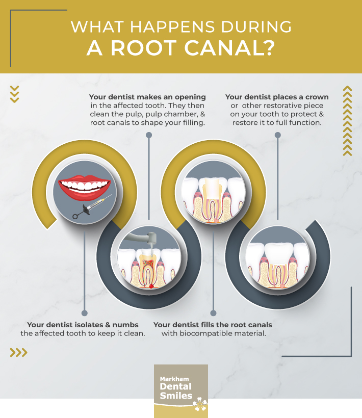 An infographic showing what happens during a root canal.