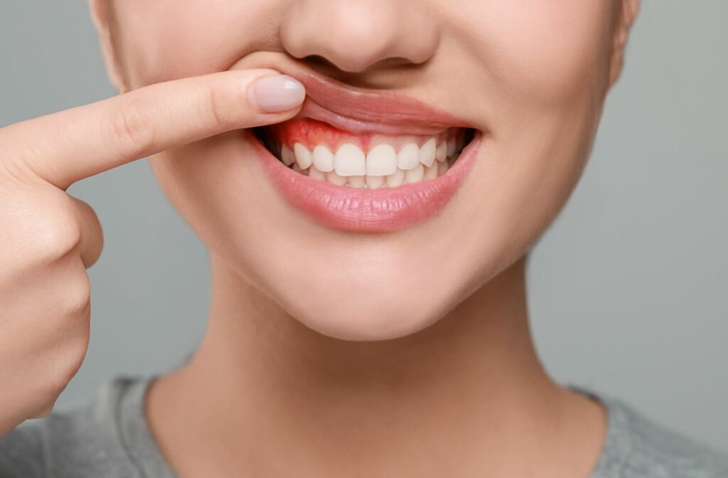 Close-up of a person's smile as they lift their right upper lip to reveal inflamed gums from smoking