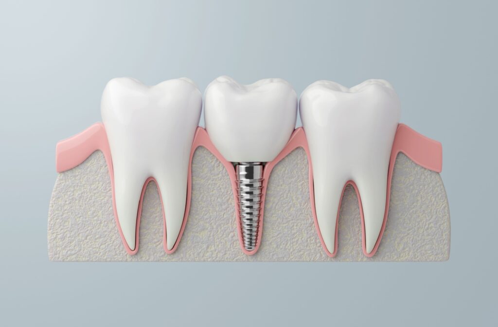 A model of 3 teeth showing below the gums with a dental implant in the middle of 2 natural teeth