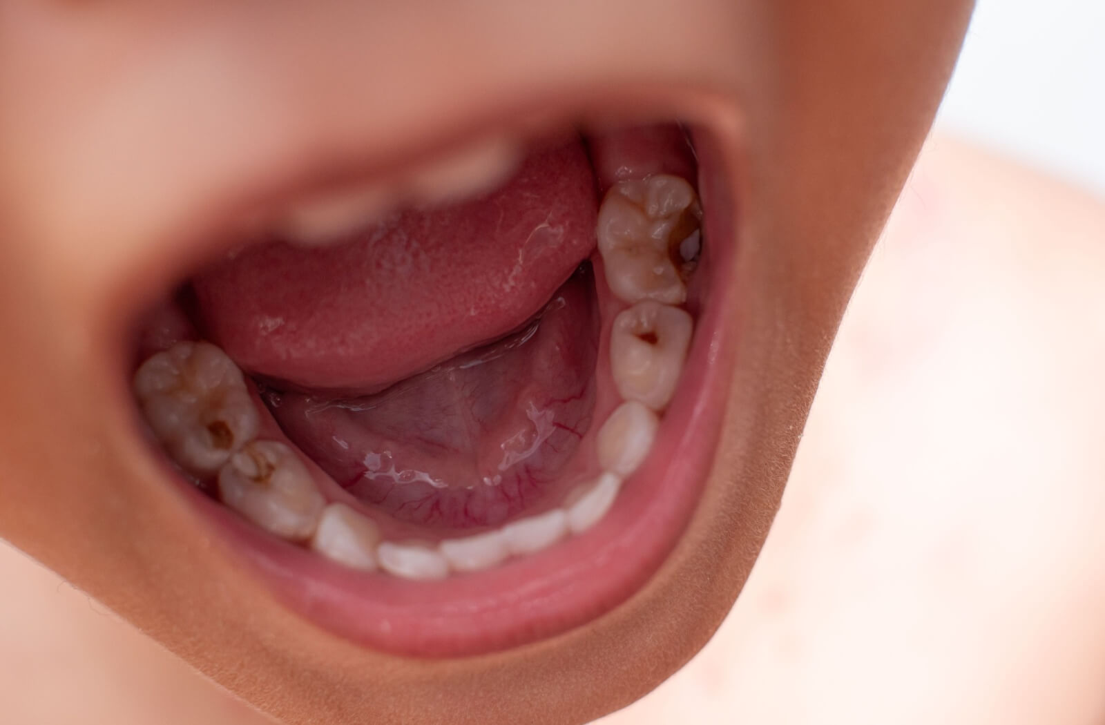 A close-up image of a child's mouth with several spots of tooth decay.