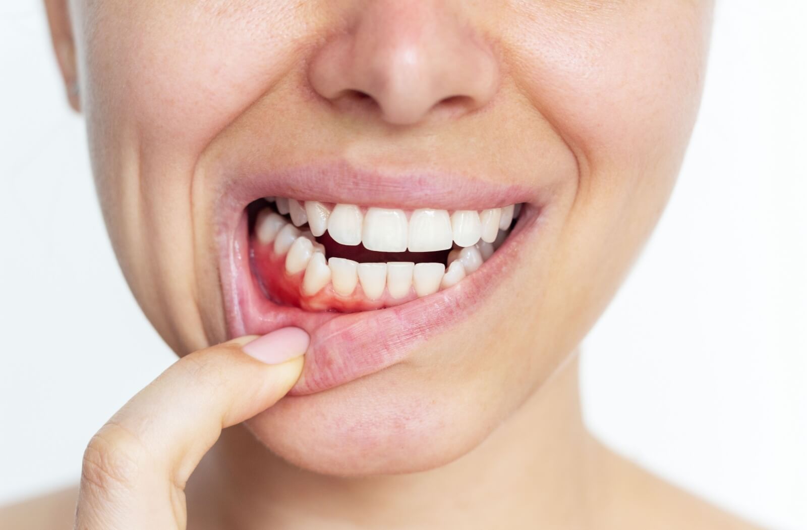 A close-up image of an adult holding their lip down to reveal red, inflamed gums.
