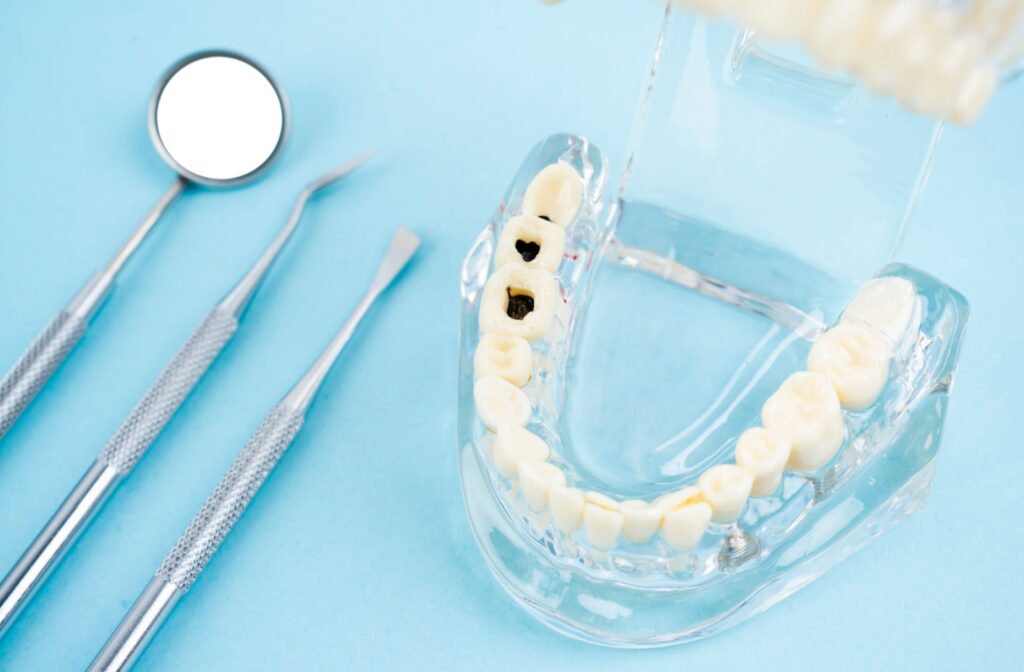 The lower molars in a dental model show deep signs of decay.