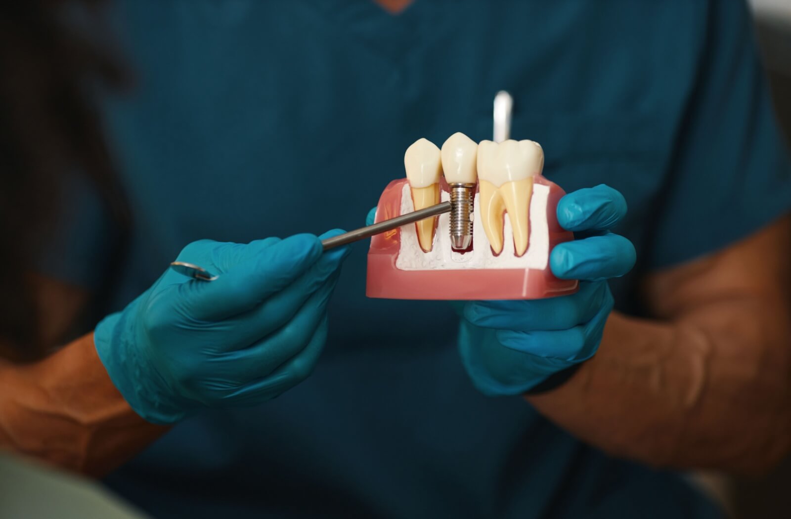 A dentist uses a dental model to explain how neglecting oral hygiene puts the dental implant and surrounding teeth at risk for serious concerns.